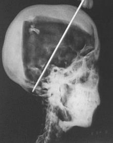 Tutankhamun x-rays
